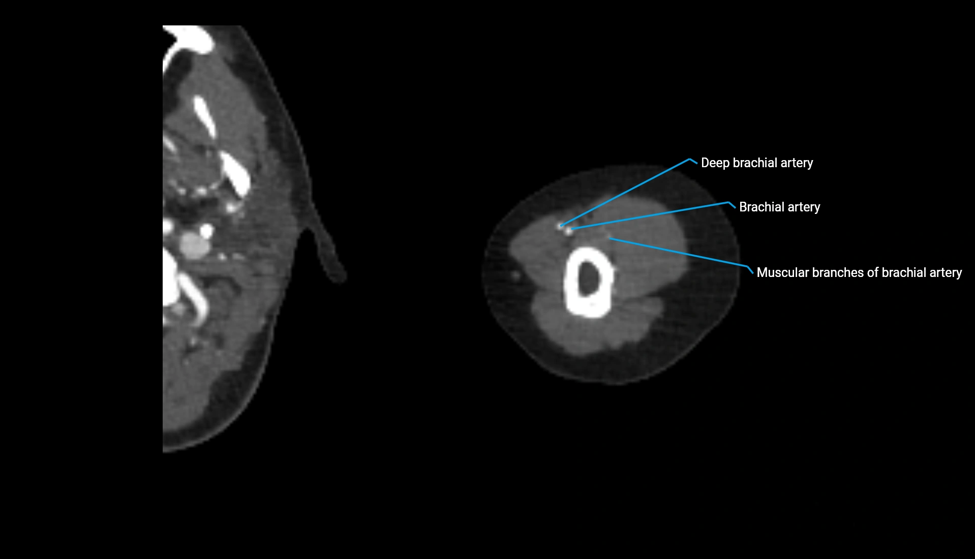 CTA upper limb axial cross sectional anatomy labelled image 274 (2).webp